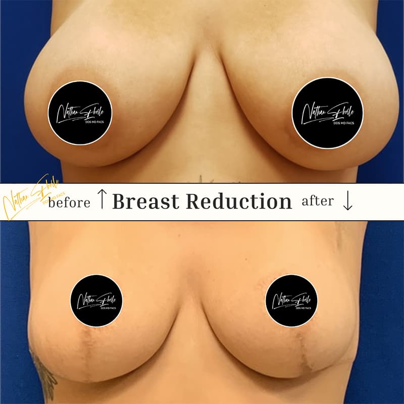 Breast Enhancement before and after result 6, actual patient at Weston Center for Plastic Surgery