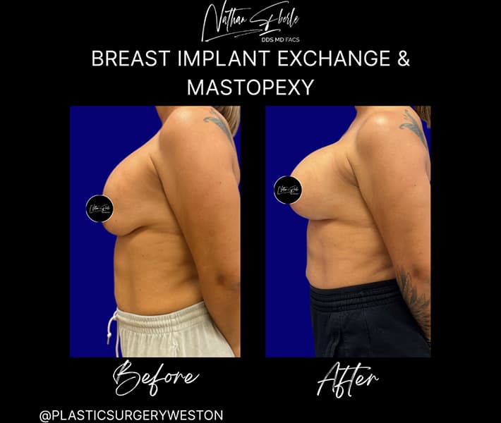 Breast Implant Exchange before and after case 10, actual patient at Weston Center for Plastic Surgery