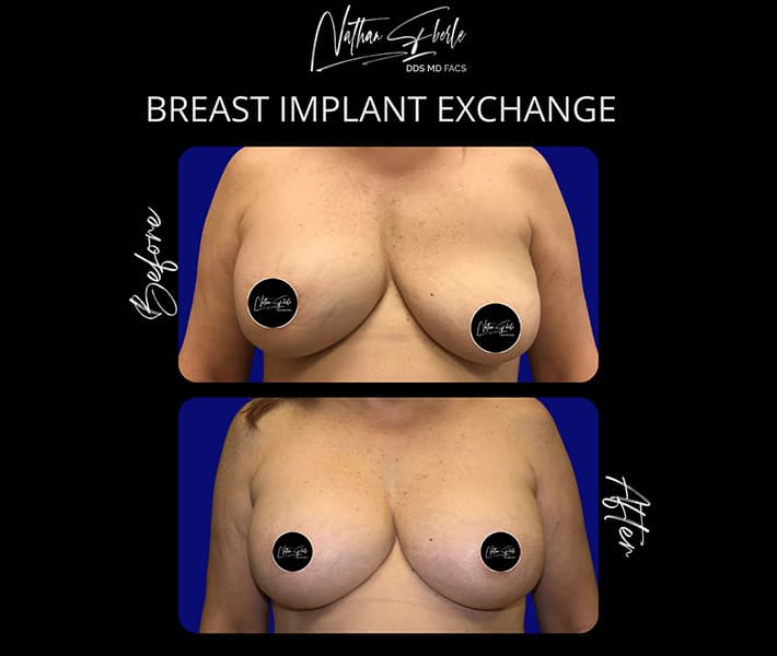 Breast Implant Exchange before and after case 15, actual patient at Weston Center for Plastic Surgery