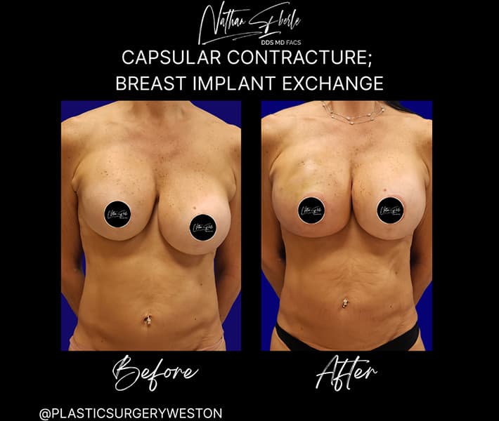 Breast Implant Exchange before and after case 16, actual patient at Weston Center for Plastic Surgery