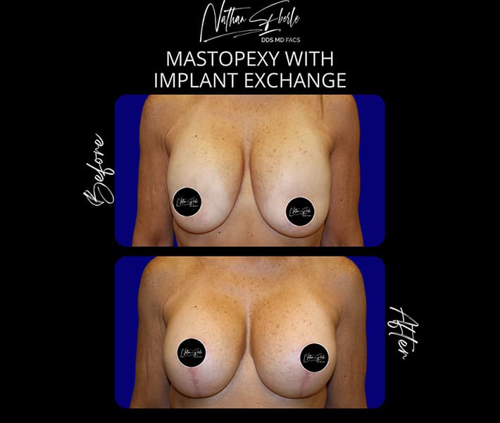 Breast Implant Exchange before and after case 21, actual patient at Weston Center for Plastic Surgery