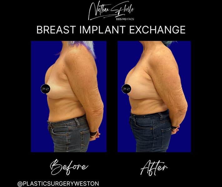 Breast Implant Exchange before and after case 25, actual patient at Weston Center for Plastic Surgery