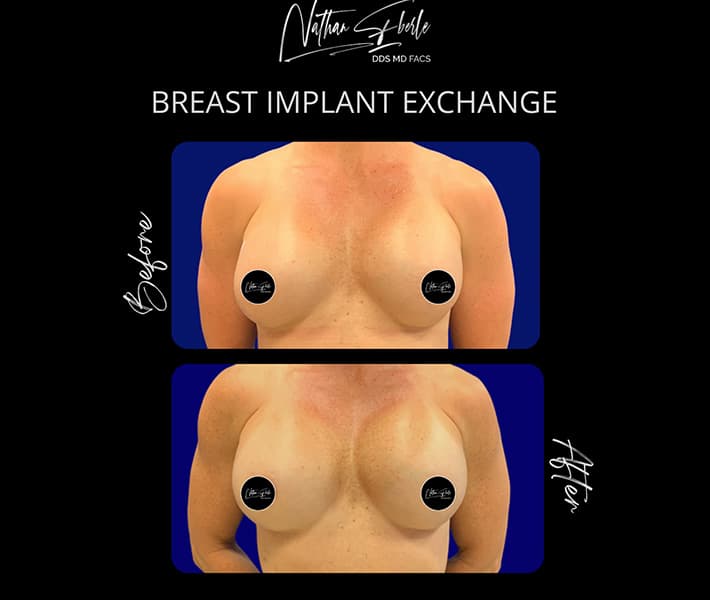 Breast Implant Exchange before and after case 26, actual patient at Weston Center for Plastic Surgery