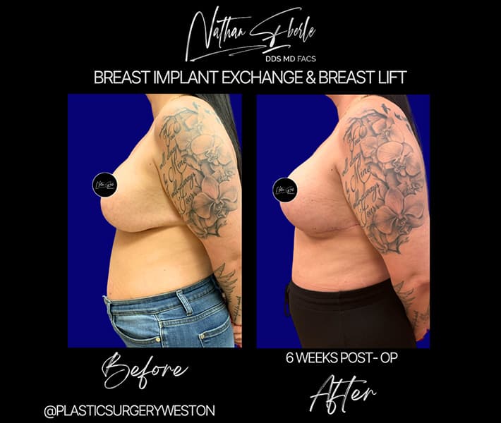 Breast Implant Exchange before and after case 27, actual patient at Weston Center for Plastic Surgery