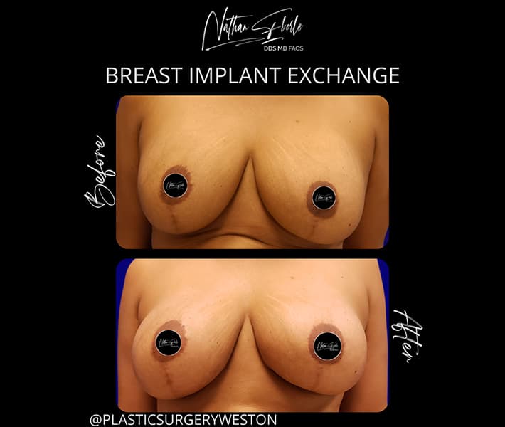 Breast Implant Exchange before and after case 29, actual patient at Weston Center for Plastic Surgery
