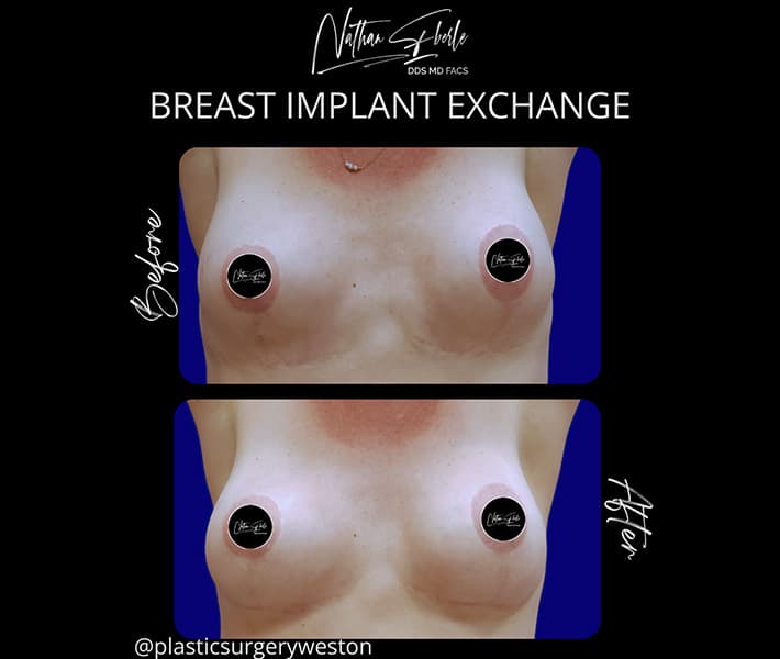 Breast Implant Exchange before and after case 3, actual patient at Weston Center for Plastic Surgery