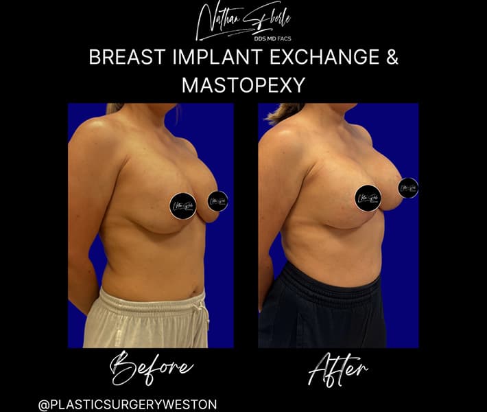 Breast Implant Exchange before and after case 30, actual patient at Weston Center for Plastic Surgery