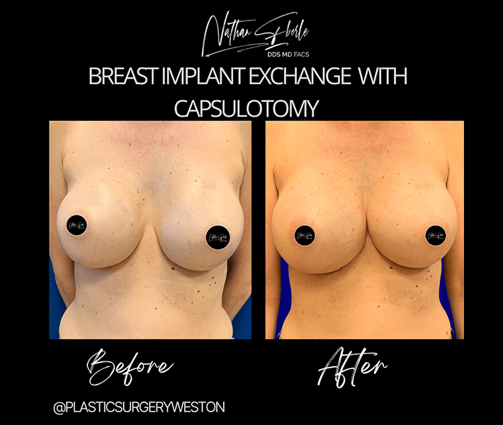 Breast Implant Exchange before and after case 33, actual patient at Weston Center for Plastic Surgery