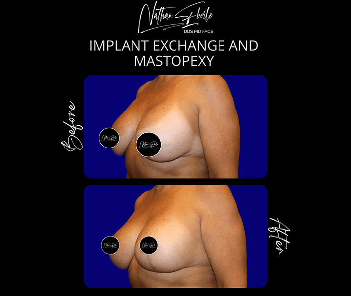 Breast Implant Exchange before and after case 37, actual patient at Weston Center for Plastic Surgery