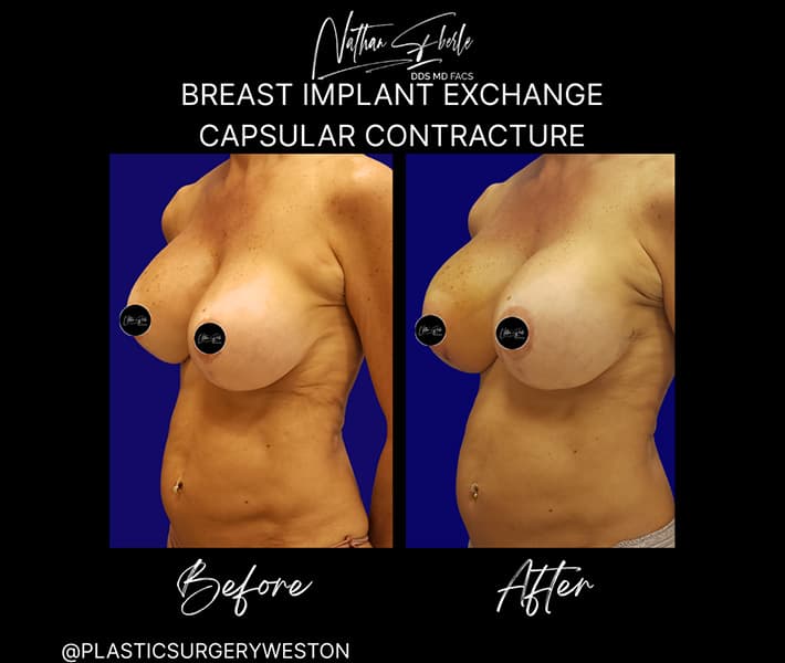 Breast Implant Exchange before and after case 4, actual patient at Weston Center for Plastic Surgery