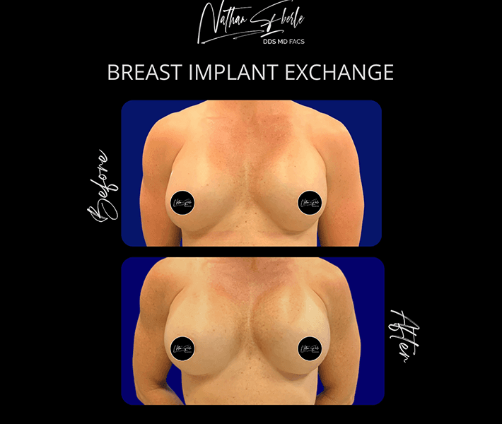 Breast Implant Exchange before and after case 43, actual patient at Weston Center for Plastic Surgery