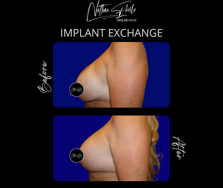 Breast Implant Exchange before and after case 5, actual patient at Weston Center for Plastic Surgery