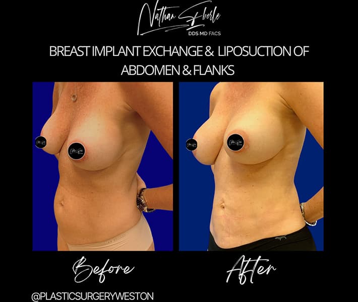 Breast Implant Exchange before and after case 7, actual patient at Weston Center for Plastic Surgery