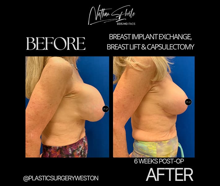 Breast Implant Exchange before and after case 8, actual patient at Weston Center for Plastic Surgery