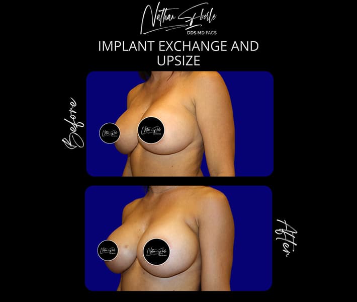 Breast Implant Exchange before and after case 9, actual patient at Weston Center for Plastic Surgery