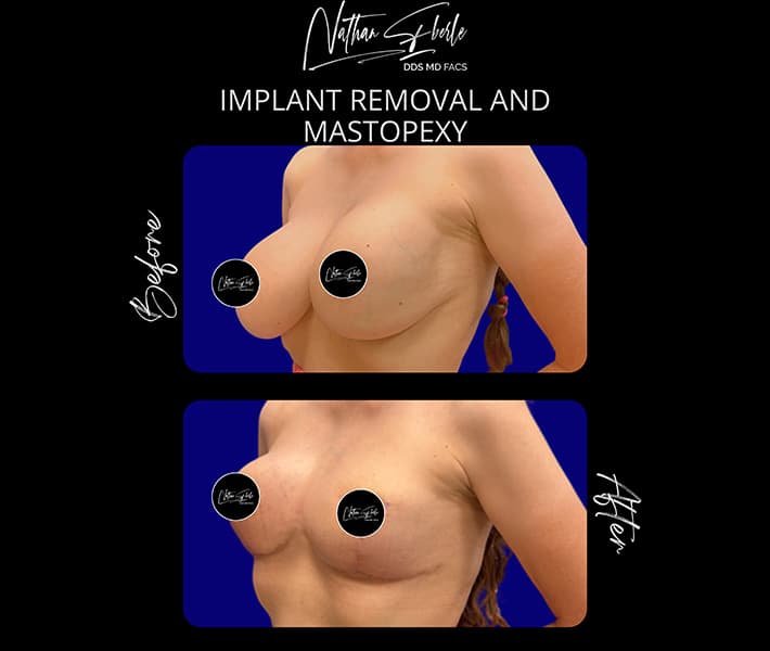 Breast implant removal before and after, case 1
