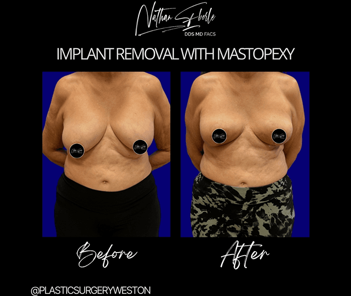 Breast Implant Removal before and after result 3, actual patient at Weston Center for Plastic Surgery