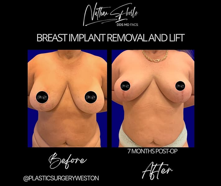 Breast Implant Removal before and after result 4, actual patient at Weston Center for Plastic Surgery