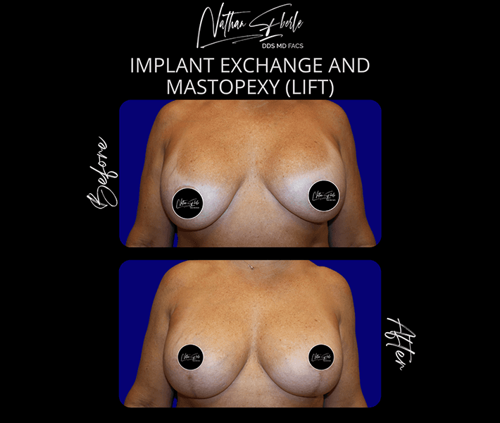 Breast Lift before and after case 14, actual patient at Weston Center for Plastic Surgery