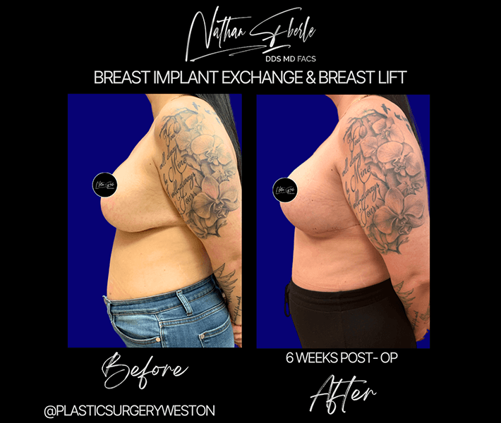 Breast Lift before and after case 16, actual patient at Weston Center for Plastic Surgery