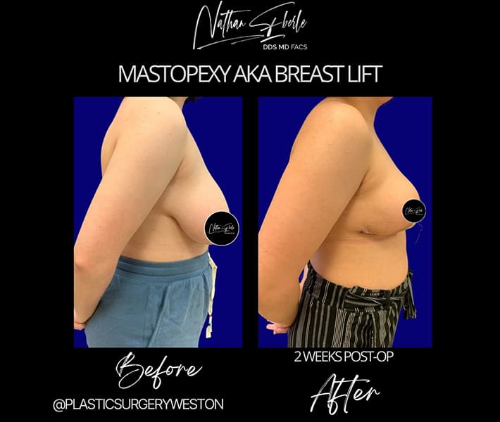 Breast lift case 2 before and after