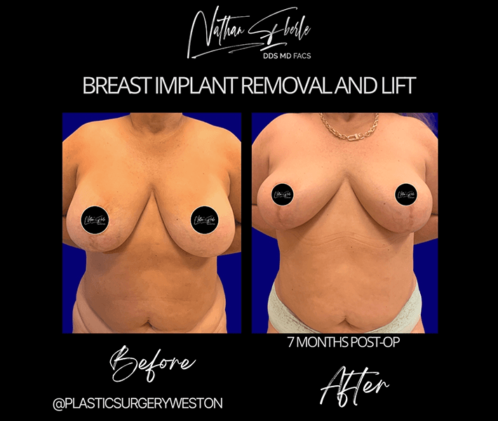 Breast Lift before and after case 26, actual patient at Weston Center for Plastic Surgery