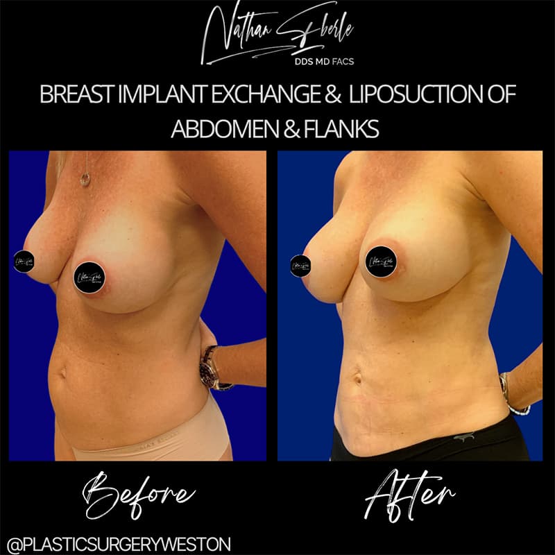 Breast Revision before and after result 1, actual patient at Weston Center for Plastic Surgery