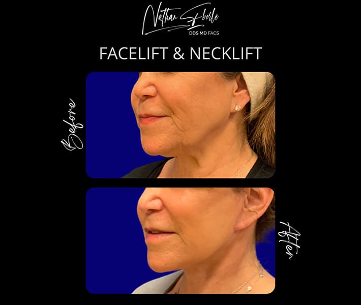 Revision facelift with natural, harmonious rejuvenation.