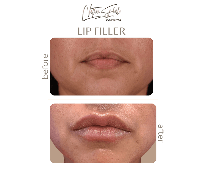 Injectable filler patient result 4