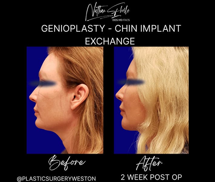 Genioplasty before and after result 1, actual patient at Weston Center for Plastic Surgery