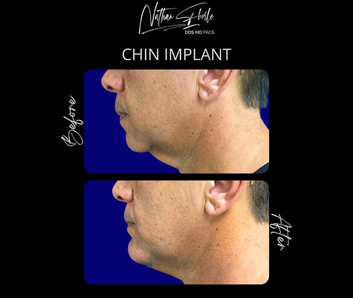 Genioplasty before and after result 10, actual patient at Weston Center for Plastic Surgery