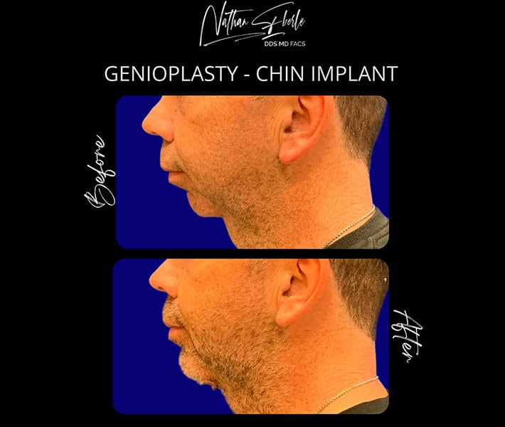 Genioplasty before and after result 11, actual patient at Weston Center for Plastic Surgery