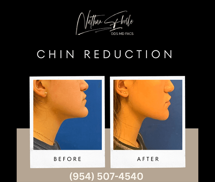 Genioplasty before and after result 12, actual patient at Weston Center for Plastic Surgery