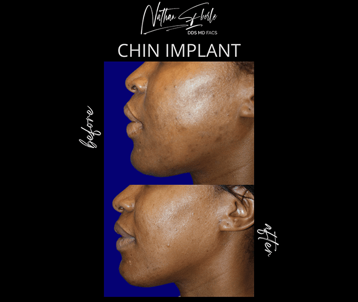 Genioplasty before and after result 14, actual patient at Weston Center for Plastic Surgery