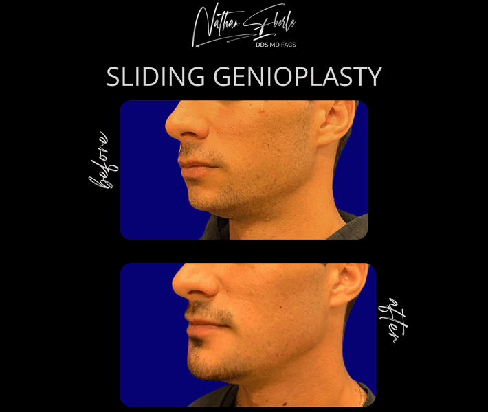 Genioplasty before and after result 12, actual patient at Weston Center for Plastic Surgery