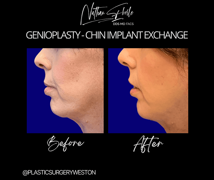 Genioplasty before and after result 2, actual patient at Weston Center for Plastic Surgery