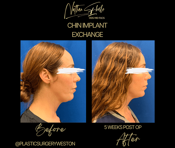 Genioplasty before and after result 3, actual patient at Weston Center for Plastic Surgery