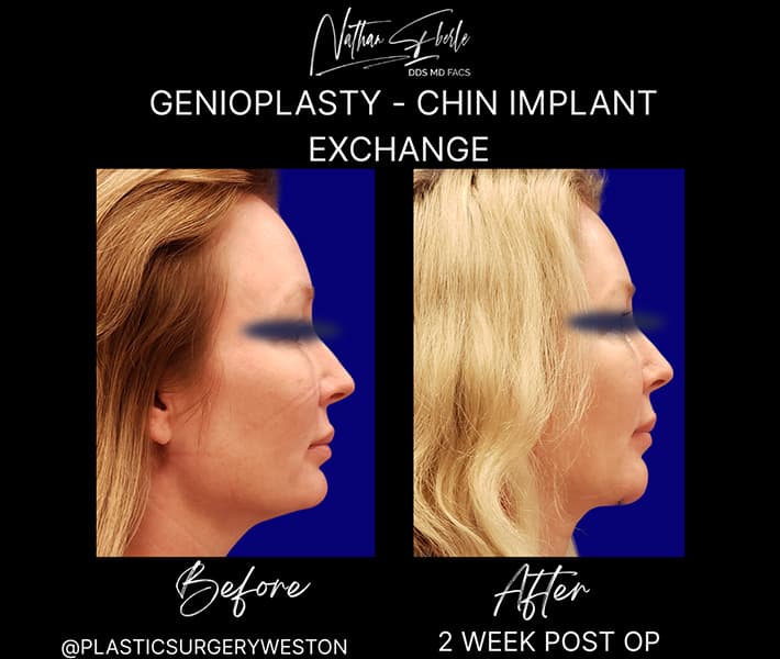 Genioplasty before and after result 4, actual patient at Weston Center for Plastic Surgery