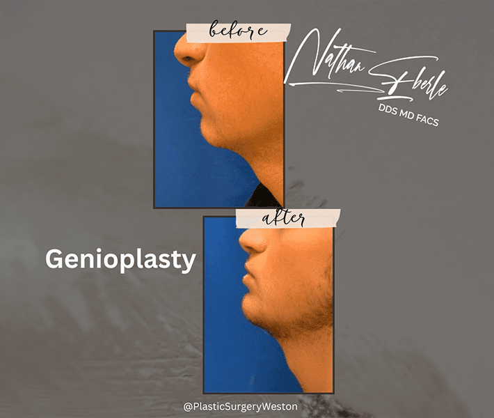 Genioplasty before and after result 5, actual patient at Weston Center for Plastic Surgery