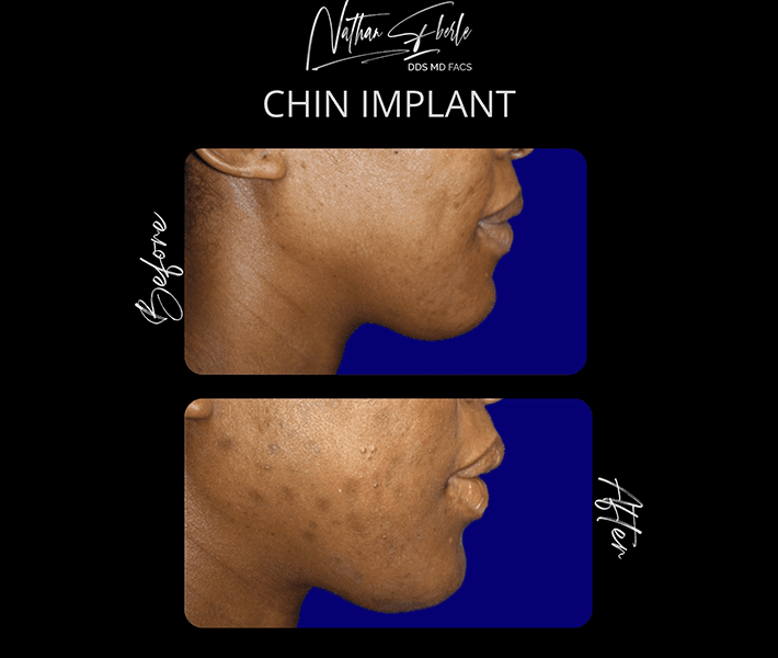 Genioplasty before and after result 6, actual patient at Weston Center for Plastic Surgery