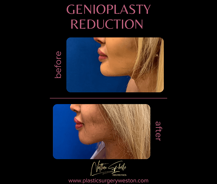 Genioplasty before and after result 7, actual patient at Weston Center for Plastic Surgery