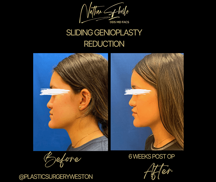 Genioplasty before and after result 8, actual patient at Weston Center for Plastic Surgery