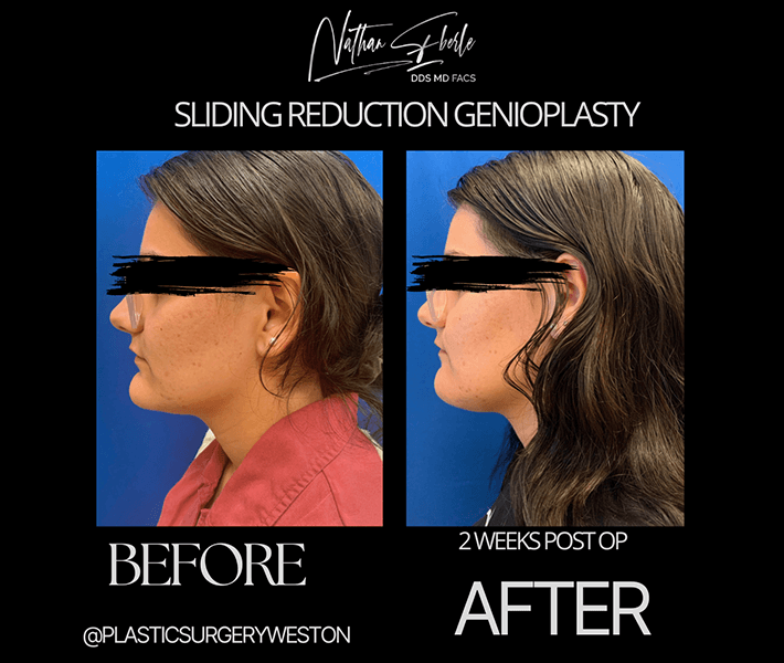 Genioplasty before and after result 9, actual patient at Weston Center for Plastic Surgery