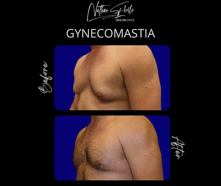 Gynecomastia before and after case 2, actual patient at Weston Center for Plastic Surgery
