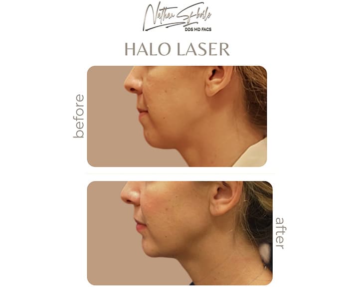 Halo Laser before and after case 1, actual patient at Weston Center for Plastic Surgery