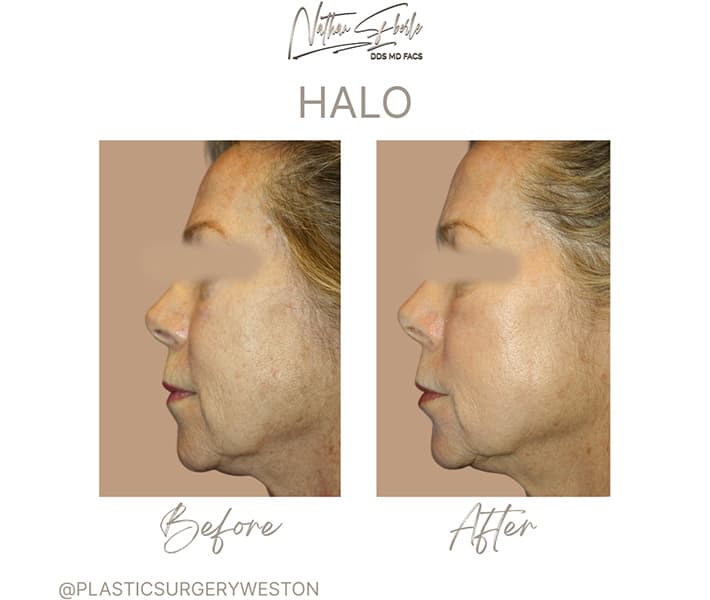 Halo Laser before and after case 2, actual patient at Weston Center for Plastic Surgery