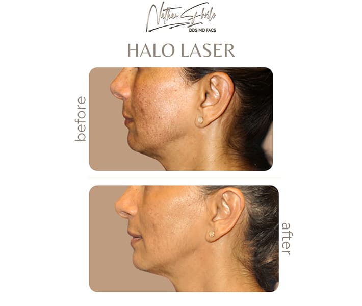 Halo Laser before and after case 3, actual patient at Weston Center for Plastic Surgery