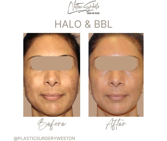 Halo Laser before and after case 4, actual patient at Weston Center for Plastic Surgery