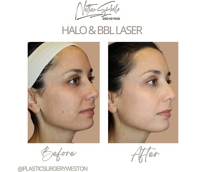 Halo Laser before and after case 5, actual patient at Weston Center for Plastic Surgery