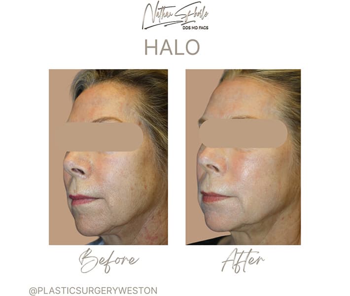Halo Laser before and after case 6, actual patient at Weston Center for Plastic Surgery